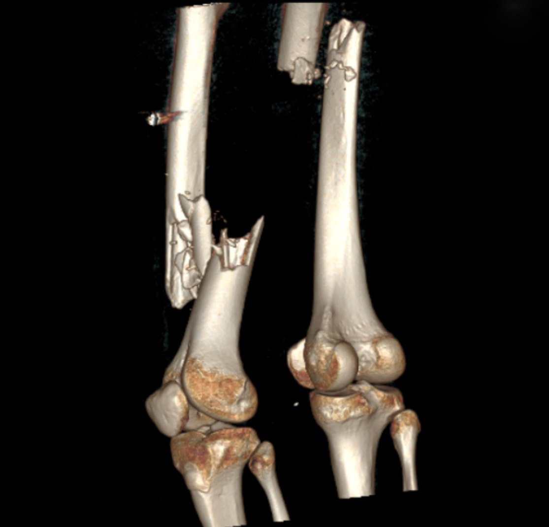 Трёхмерное изображение перелома костей ноги.