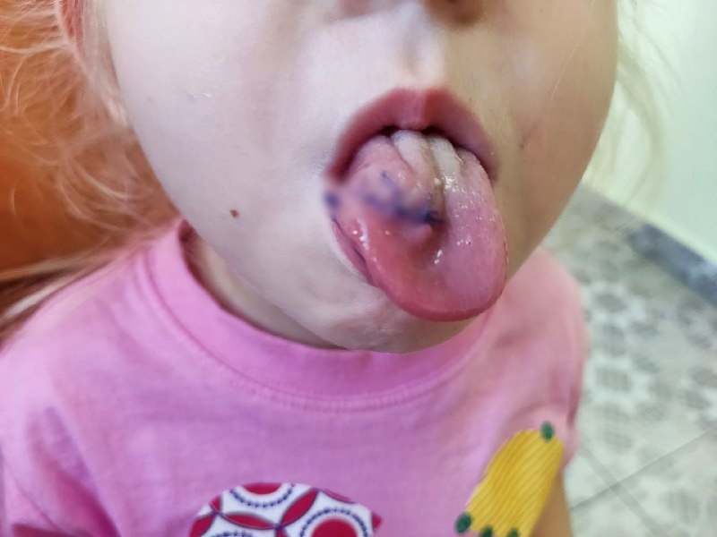 Иркутские хирурги прооперировали ребенка с разорванным пополам языком