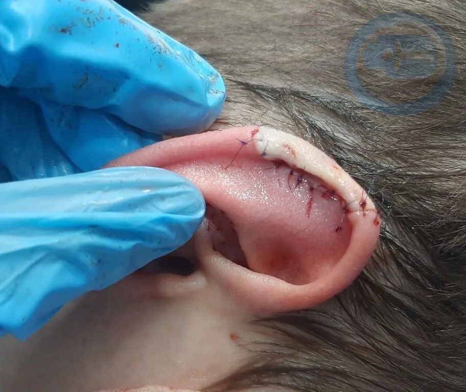 Иркутские медики успешно пришили мальчику кусок уха, откушенный собакой