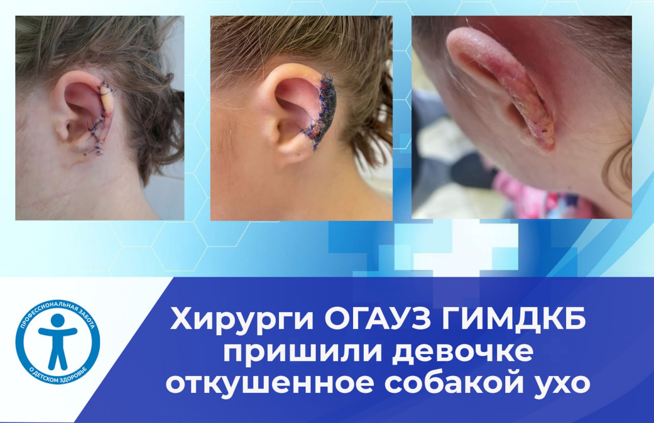 Иркутские врачи пришили девочке часть уха после укуса собаки
